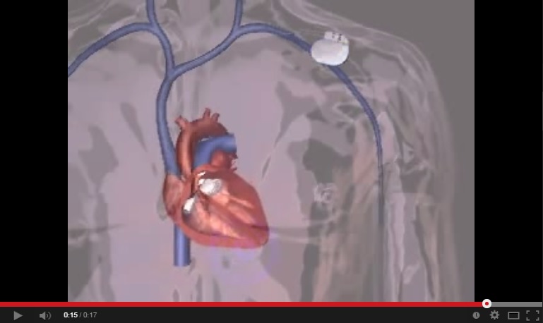 Video that shows Animation of Implanting a Pacemaker 